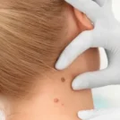 skincancer